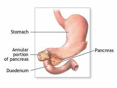 胰腺恶性肿瘤 胰腺恶性肿瘤是什么 双峰女孩患胰腺恶性肿瘤，3D手术切除拳头大肿瘤！