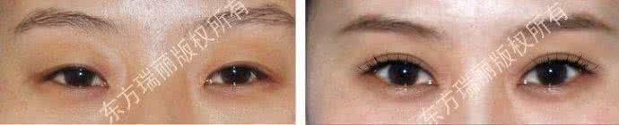 双眼皮会不会隔代遗传 两个单眼皮能生出双眼皮吗