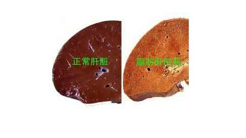 脂肪肝表现的症状 脂肪肝的7大症状