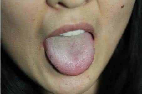 小儿舌诊辨证图谱 舌诊那点事儿（二）