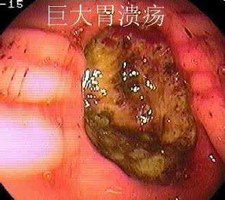 治胃溃疡的最特效偏方 胃炎、胃溃疡、胃出血的特效偏方