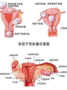 子宫肌瘤的治疗方法 子宫肌瘤的治疗方法 子宫肌瘤如何饮食