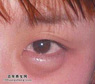 眼皮跳怎么缓解 缓解眼皮跳 上眼皮肿是怎么回事？有效缓解上眼皮肿的方法