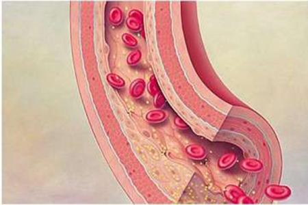 脑血管硬化吃什么好 脑血管硬化的症状 脑血管硬化吃什么好