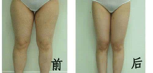 大腿吸脂多久消肿 大腿吸脂多久消肿 站久了大腿肿了怎么办?
