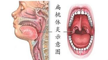 急性化脓性扁桃体炎 治疗急性化脓性扁桃体炎妙方*