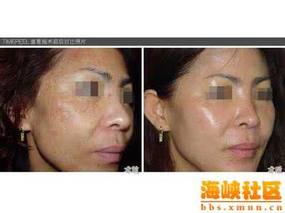 阿司匹林美白祛斑法 阿司匹林祛斑 阿司匹林这样用效果最好,一夜祛斑,七天美白返老还童。