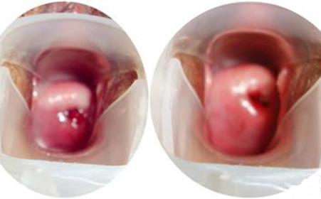 宫颈息肉手术注意事项 宫颈息肉手术后症状以及注意的事项