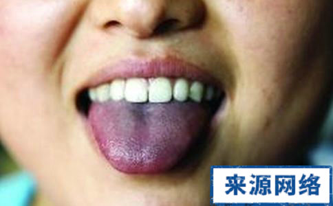 舌苔发黑是什么病早期 舌苔发黑是什么病早期 舌苔发黑的治疗方法