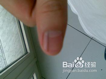指甲上有竖纹怎么治疗 指甲有竖纹的成因及治疗方法