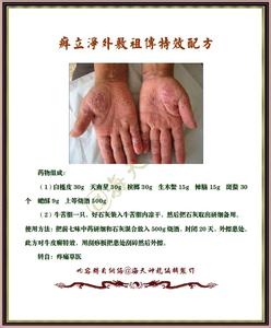 外敷祖传绝技秘方 图文:外敷特效“癣立净”祖传配方
