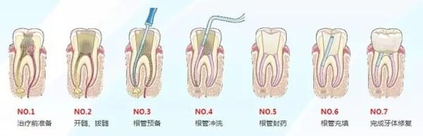 蛀牙根管治疗多少钱 严重蛀牙不做根管治疗 蛀牙没喊痛就不严重？医生却告诉你要做根管治疗！