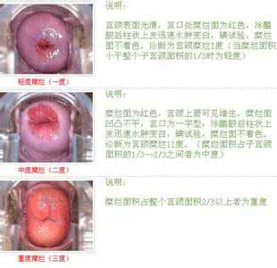 治疗宫颈炎最好的药 治疗宫颈炎用什么药 宫颈炎怎么治疗最好