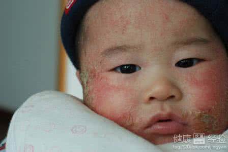 新生儿湿疹用什么药好 新生儿湿疹用什么药 新生儿湿疹用什么药才好