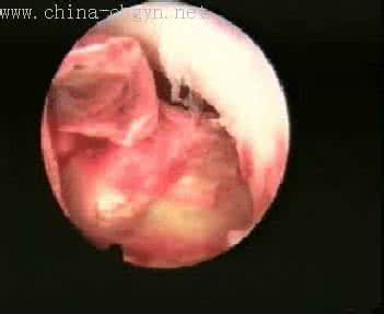 子宫内膜结核的症状 子宫内膜结核 子宫内膜结核有哪些症状