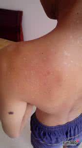 汗斑注意事项 得了汗斑生活上要注意什么