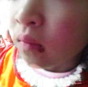 口角溃疡怎么办 口角溃疡 口角溃疡 它是如何发生的