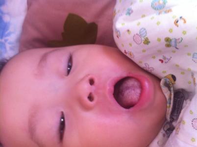 生姜贴肚脐眼有何作用 孩子拉稀，姜贴肚脐