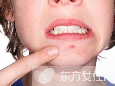 治疗青春痘的民间偏方 青春痘的治疗小偏方 青春痘偏方