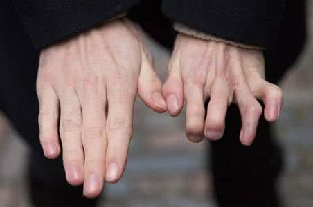 脚趾移植到手指上 男子手指断13年 医生成功移植脚趾到手指上