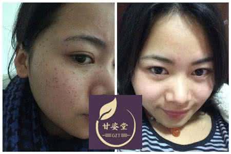 去除色斑方法 色斑的去除方法 中医去除色斑方法是什么