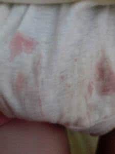 伤心过度引发的疾病 少女过度自慰会引发什么问题：为什么手淫后白带会增多