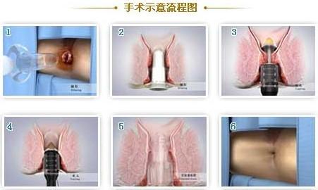 痔疮治疗用什么药 痔疮用什么药 轻松治疗痔疮