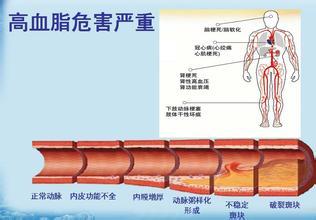甘油三酯偏高的症状 甘油三酯偏高的症状、危害