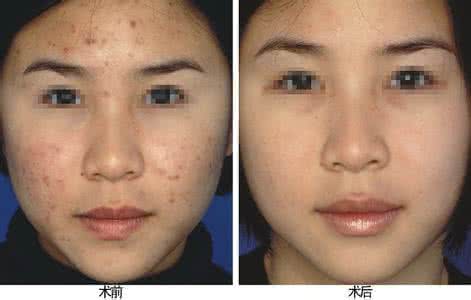 毛孔排污 青春痘问题毛孔排污是关键