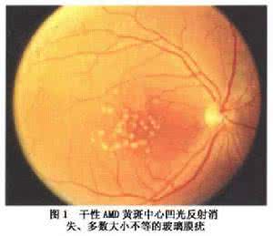 眼底黄斑变性能治吗 黄斑变性 看东西变形 警惕黄斑变性