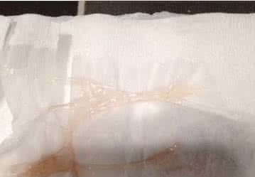 白带拉丝是怎么回事 白带拉丝是怎么回事 白带拉丝的性状