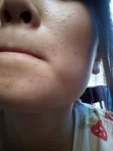 闭合性粉刺怎么治疗 闭合性粉刺怎么治疗 这些方法教你轻松去粉刺