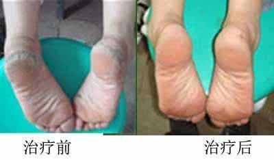 手足癣病因 手足癣的病因是什么 足癣的具体病因说明