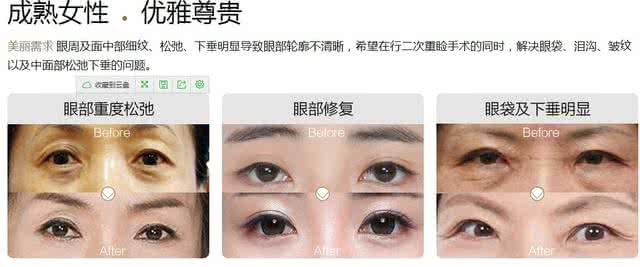 上海眼部整形医院 上海眼部整形医院 眼部整形最关心的六个问题