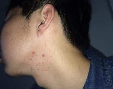 真实丰胸经验分享 真实丰胸经验分享 脖子上长痘痘是什么原因? 最真实的经验分享