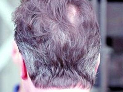 后脑勺下有痣藏头发里 你知道吗?后脑勺竟藏有一神奇功效