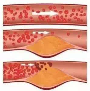 心脏一根血管堵要紧吗 这根血管最容易堵