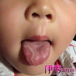 小孩舌头溃疡怎么办 小孩舌头溃疡怎么办 小孩舌头溃疡的病因