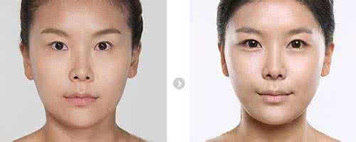 面部玻尿酸除皱的价格 面部玻尿酸除皱需要多少钱 面部玻尿酸除皱需要多少钱