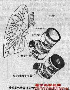 慢性支气管炎 第三节　慢性支气管炎