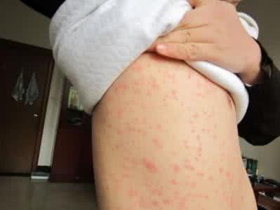 结节性红斑病因 结节性红斑病因 结节红斑 它的病因有哪些