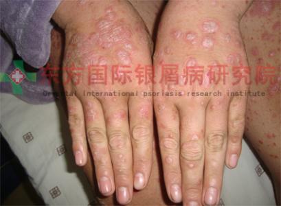 风湿性关节炎疾病 秋季易发疾病 牛皮癣久病易发关节炎