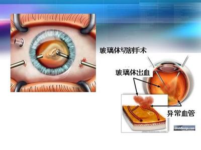 高血压性视网膜病变 高血压视网膜病变 高血压视网膜病变怎样护理