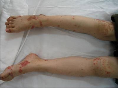 过敏性紫癜肾炎能自愈 过敏性紫癜性肾炎 中医治过敏性紫癜性肾炎