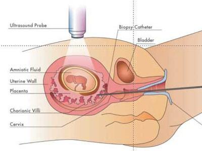 做了绒毛穿刺后更害怕 绒毛穿刺怎么做