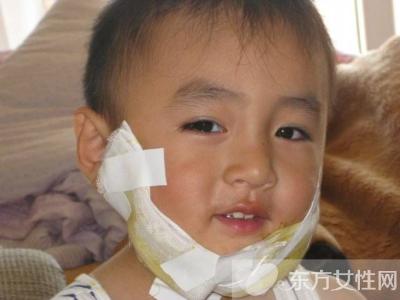 流行性腮腺炎治疗 腮腺炎治疗腮腺炎的秘方