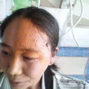 老年人带状疱疹 老年人带状疱疹 老年人带状疱疹要及时查肿瘤