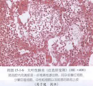 大叶性肺炎的治疗 大叶性肺炎的治疗 老年大叶性肺炎的概述