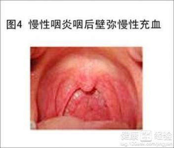 咽喉炎的最佳治疗方法 咽喉炎的治疗 这样治疗咽喉炎比较好