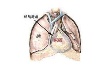 纵膈肿瘤症状 纵膈肿瘤 纵膈肿瘤有哪些症状